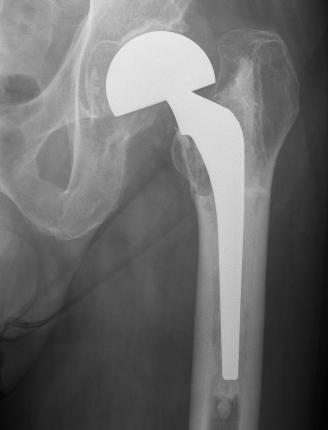 Revision Femur Paprosky 1 